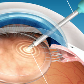 MICS - удаление катаракты через микропрокол 1,8 мм