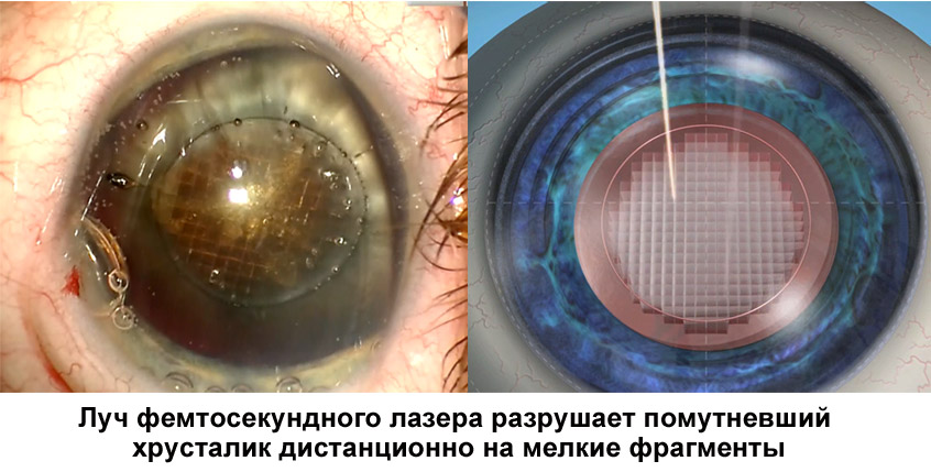 Фемтосекундное сопровождение хирургии катаракты что это