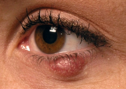 Халязион и гордеолум (ячмень) - Заболевания глаз - Справочник MSD Профессиональная версия