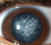 Симптомы начальной катаракты