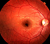 Ожог сетчатки глаза: последствия, симптомы, лечение