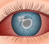 Ожоги глаз: первая помощь и лечение